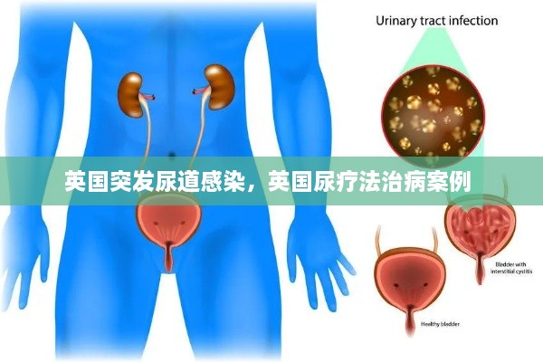 英国突发尿道感染，英国尿疗法治病案例 