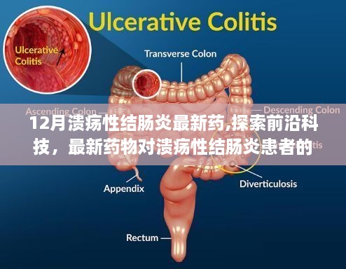 探索前沿科技，最新药物解析为溃疡性结肠炎患者带来福音