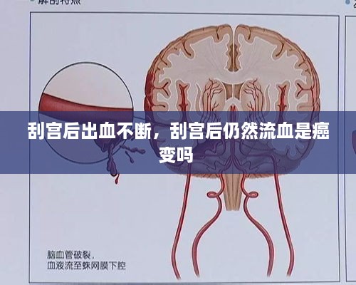 刮宫后出血不断，刮宫后仍然流血是癌变吗 