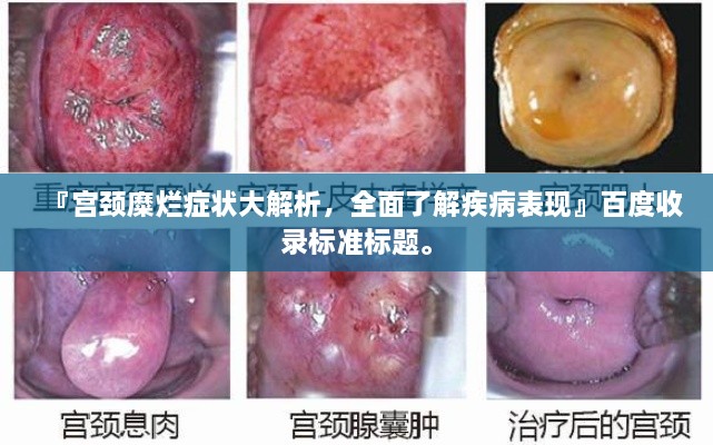 『宫颈糜烂症状大解析，全面了解疾病表现』百度收录标准标题。